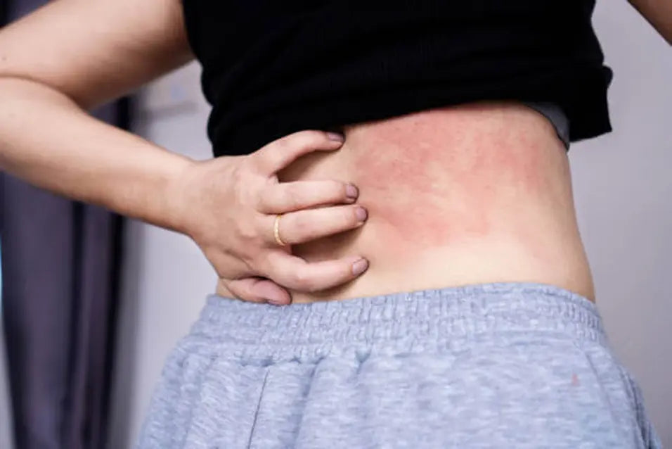 allergic reaction to vitamin b12 injection Can Injections Cause Nasty Rashes? Vitamin B12 Injection Service -