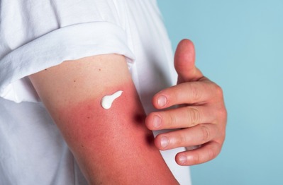 applying lotion to red sunburned arm